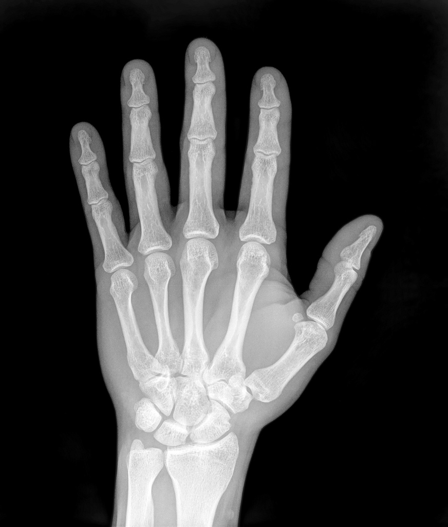 x-ray of hand