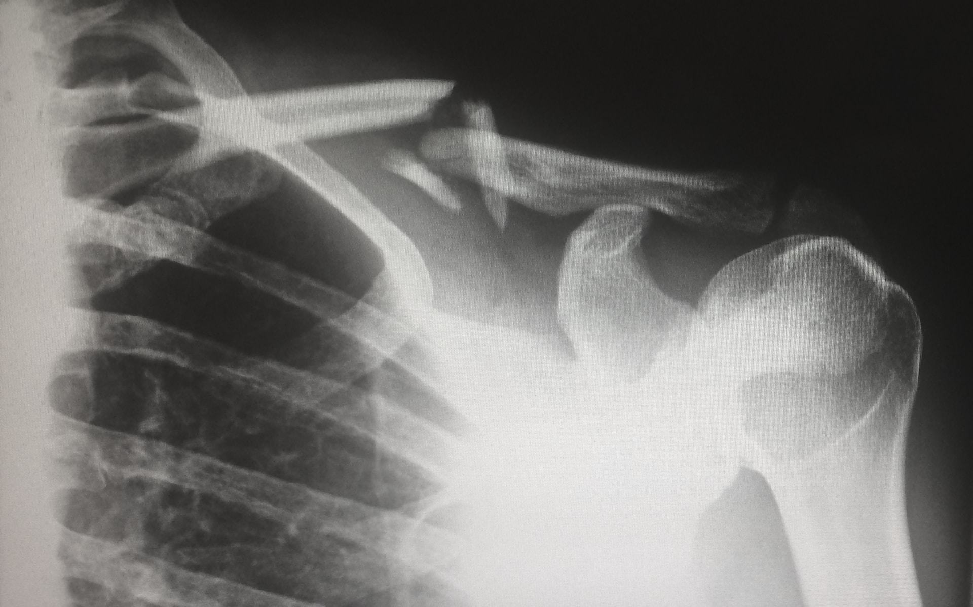 broken bone x-ray -personal injury lawsuits in Arizona